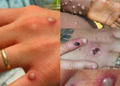 Monkeypox Global Cases